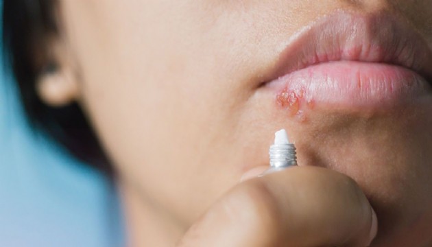 Uçuk ve Alzheimer arasında bağlantı keşfedildi